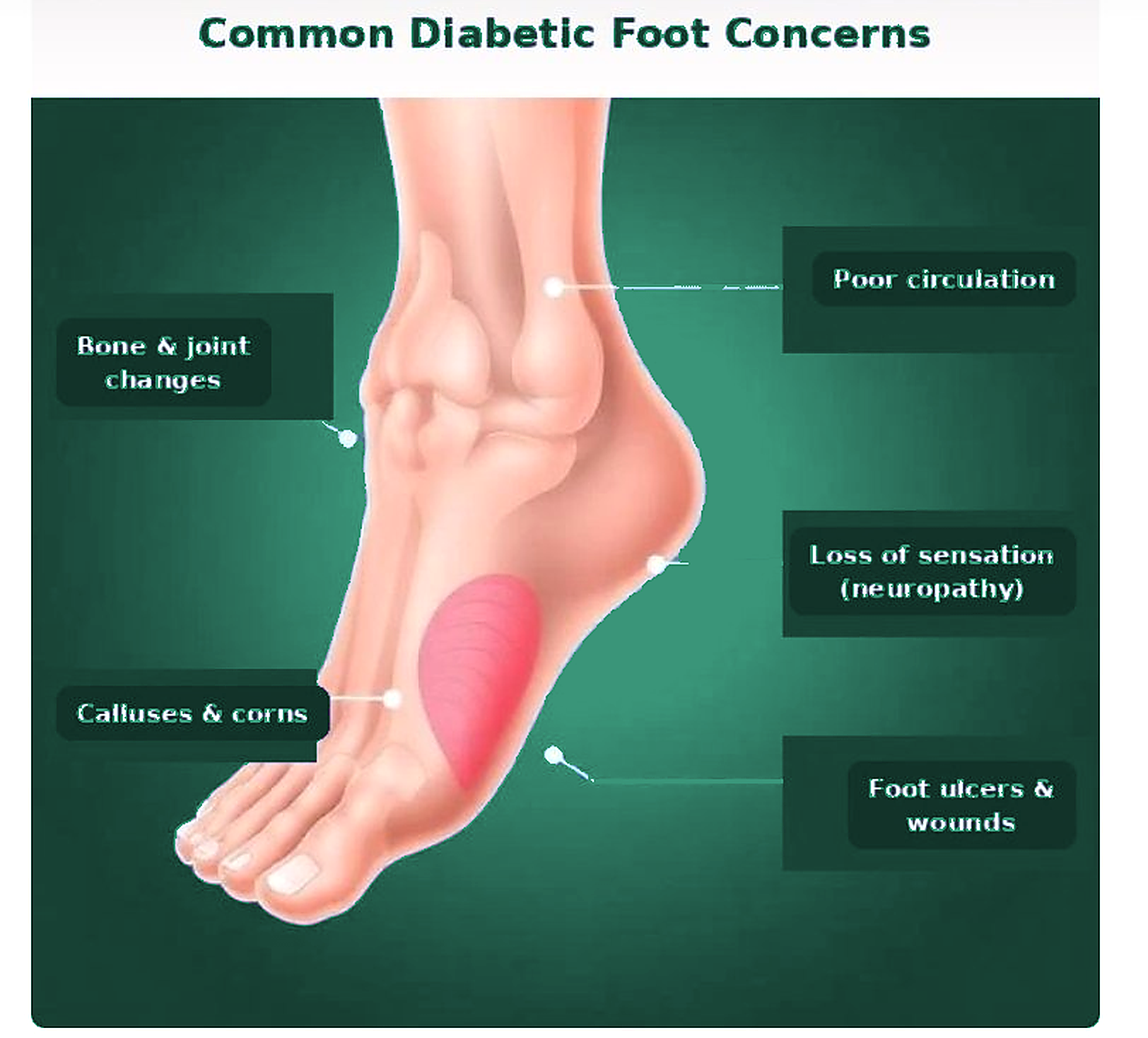 Common Diabetic Foot Concerns